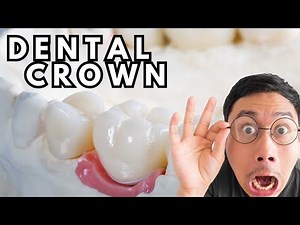 Dental Crown Procedure Animation EXPLAINED