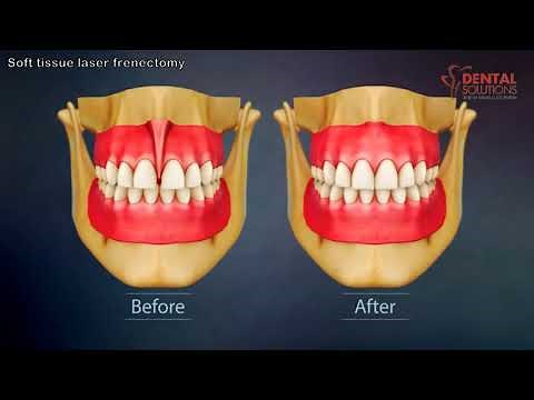 Soft tissue laser frenectomy for reducing gap between teeth