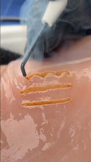 Dental Electrosurgery Made Easy with Domed Unit!⚡#shorts #dentist #healthcare #short