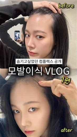 진짜 숨기고싶었던 컴플렉스 대공개..!🥹100% 내돈내산으로 받은 시술...!모발이식한지 3달 반이 된 지금도 너무 만족하고 있어 영상 낋여왔어요...(칭찬해줘요...😽)