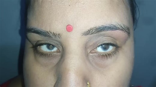 Understanding Nystagmus: Causes, Symptoms, and Types | Fiza zahra zaidi posted on the topic | LinkedIn