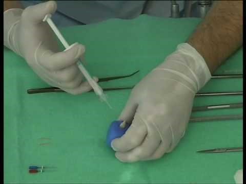 iRoot SP Root Canal Filling - Dr Kosev's Technique