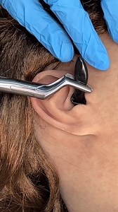 Strange insect removed from ear | Lists and Laughs