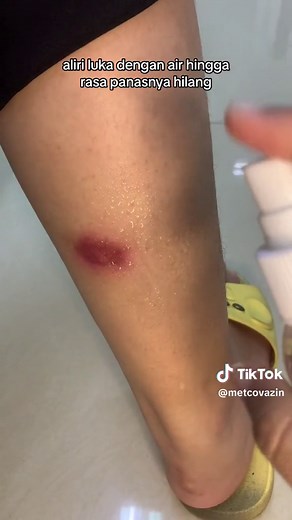 Cara Mudah Rawat Luka Knalpot Tanpa Bekas