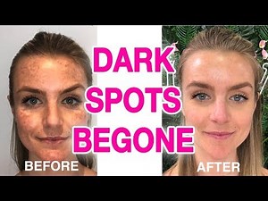 THE ULTIMATE DARK SPOT REMOVER GUIDE