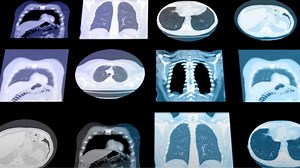 Sybil: An AI model that can predict lung cancer risk 6 years in advance | Eduardo E Chang MD, M.