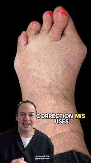 How to fix a bunion?!