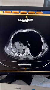 Why an Infection Can Move Your Heart #shorts