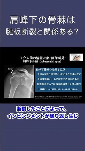 【肩関節のレントゲン読影③】肩峰下骨棘/腱板断裂と深い関係がある？