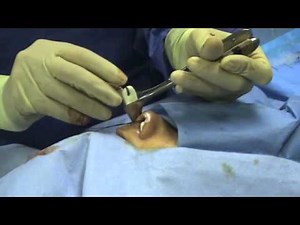 Taponamiento nasal con Merocel