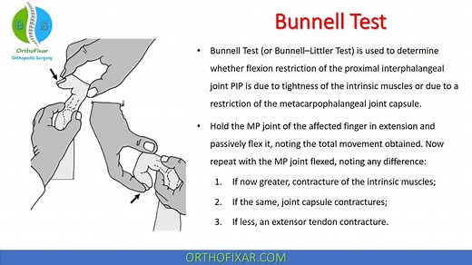 Bunnell Test For Intrinsic Tightness Explained Easily | OrthoFixar