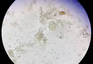 Balantidium coli trophozoite | Iraqi Medical Laboratory Association