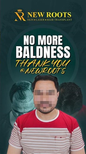 4000 Grafts Hair Transplant in Pune | Diffuse Baldness #hairtransplantpune #shorts