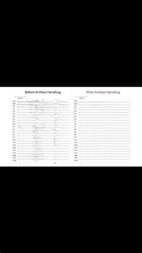 How Filtering Reveals Brain Rhythms
