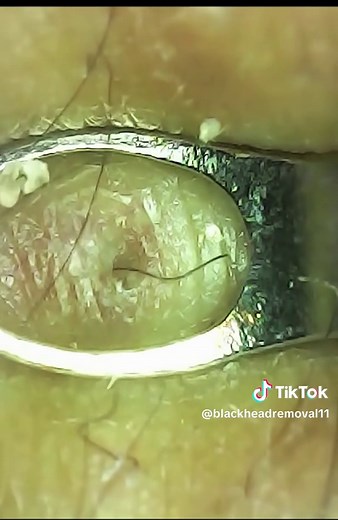 Huge black head extracted fully😍 How does my dad keep getting these?? #pimplepop #satisfying #foryou #pimple