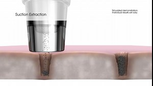 Spa Sciences MIO Replacement Treatment Head – Microdermabrasion Replacement Tip – Professional Grade Exfoliation