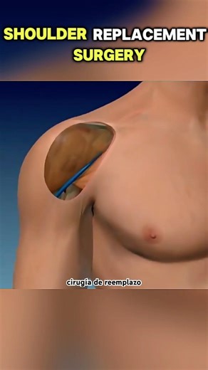 Shoulder replacement surgery (3D Animation)#ShoulderReplacement #JointReplacement #MedicalWorld3D