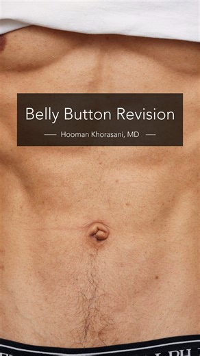 Hooman Khorasani, MD, FAAD, FACMS, FAACS on Instagram: "Umbilicoplasty (outie to innie belly button surgery) is one of the most underrated confidence-boosting procedures. The facts: ✓ 45-minute procedure under local anesthesia ✓ Scar hidden inside the belly button ✓ Back to gym in 3 weeks ✓ Permanent, natural results Sometimes the smallest changes create the biggest impact. If you’ve been thinking about this, let’s talk. #Umbilicoplasty #BellyButtonSurgery #MalePlasticSurgery #BeforeAndAfter #Bo
