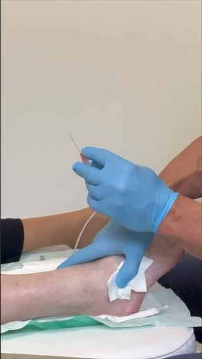 Ultrasound guided injections for Ankle and subtalar joint arthritis.
