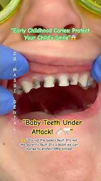 “Early Childhood Caries: Protect Your Child’s Smile”