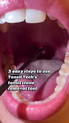 We make removing your tonsil stones easy and help keep your breath clean! 🦷🪥 #clean #satisfyingvideo #teeth #tonsilstones #dentalhygienist #womenshealth