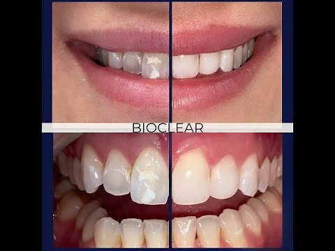 Bioclear - The Best Alternative to Veneers and Bonding - Patient Testimonial