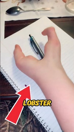 Lobster Syndrome |Ectrodactyly |Born Different