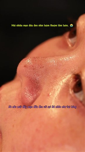 3 bước trị mụn đầu đen trên mũi — mịn sạch sau 1 tháng