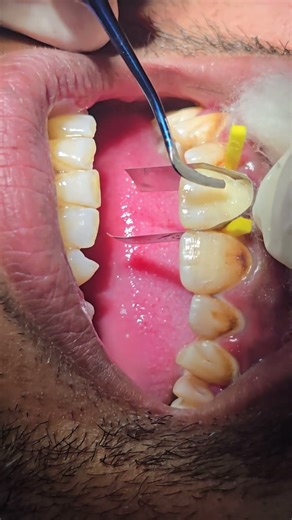Direct composite restoration #dentist