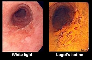 Chromoendoscopy - Alchetron, The Free Social Encyclopedia