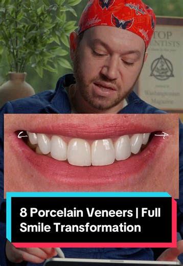 Transform Your Smile with 8 Porcelain Veneers