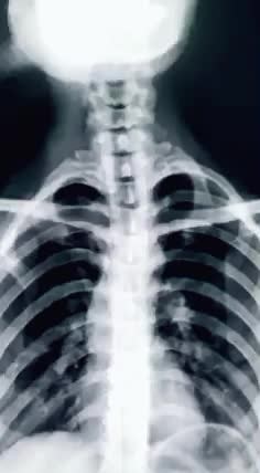 A barium swallow is a medical test where a person swallows a special liquid called barium. This liquid helps doctors see the upper digestive system, including the esophagus, stomach, and first part of the small intestine, on X-ray or fluoroscopy. It's used to diagnose problems like ulcers, tumors, and swallowing difficulties #simpletrickforlearning #lecture #radiologyimages #viral #fypシ #veiws #foryoupage #1000 #ExamReady #vedio #procedure #bariumswallow #needviews @TiktokPakistanOfficial @foryo