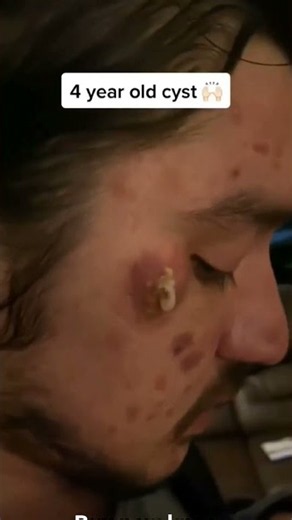 4 year old cyst