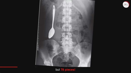 Most shocking things found inside a human body