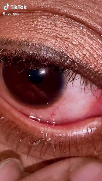 Eye goo on TikTok