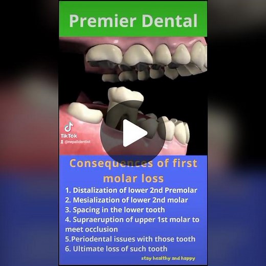 Consequences of First Molar Tooth Loss Explained