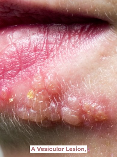 🔬 Herpes is one of the most misunderstood viruses on the planet — here's what's actually going on. Herpes causes vesicular lesions — blister-like sores that ulcerate, crust, and scab as they heal. It's caused by two different viruses: HSV-1 — most commonly associated with cold sores and fever blisters around the mouth and lips. Often contracted during childhood through direct oral contact like kissing — sometimes from a parent or sibling with an active lesion. 👶 HSV-2 — most commonly associate