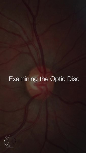 Understanding Optic Disc in Ophthalmology: ISNT Rule & Glaucoma