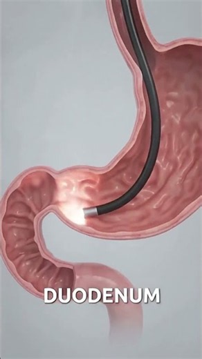 Understanding the EGD Procedure|Medical Coding Course|CPC Certification Training|CPT|Surgery|40000