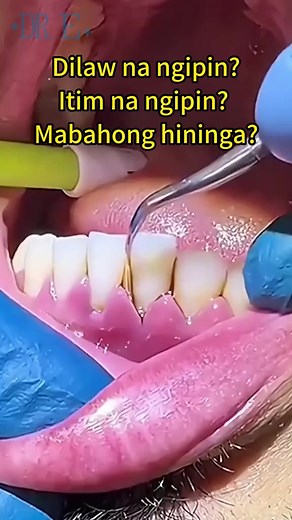 Effective Toothpaste for Whiter Teeth and Stain Removal