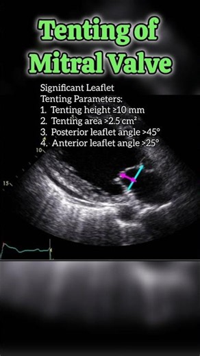 Mitral Valve Tenting Parameters - Echocardiography for Beginners