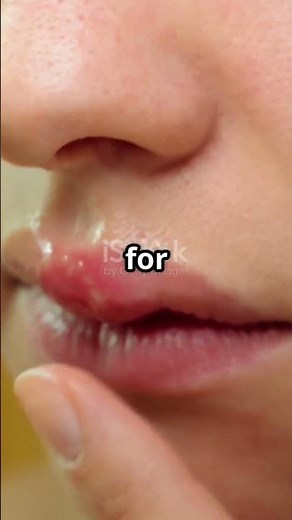 Sunburned Lips? Try This 3-Ingredient DIY Lip Fix