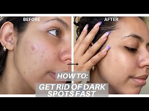 Help Visibly Reduce Dark Spots and Hyperpigmentation Ft. Hyper Skin | Sephora