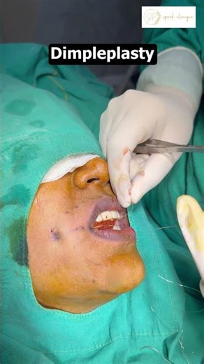 Dimple Creation Surgery | Before & After | Dimpleplasty by Dr. Shalu Punj