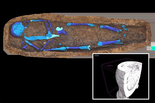 Mysterious calcified 'porcelain gallbladder' found inside 100-year-old remains