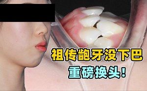 又一重磅案例！祖传骨性龅牙没下巴！成功换头！