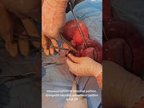 Surgical Management of Intestinal Intusseption
