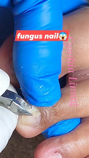 cut fungus nails to grow faster #fungus #fungusnails #dryskin #pedicure #ingrowntoenail #ingrowntoenailremoval #pedicuretime | Cynthia M. Lintag