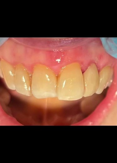 RCT-Post-Fill: Upper Left Lateral Incisor