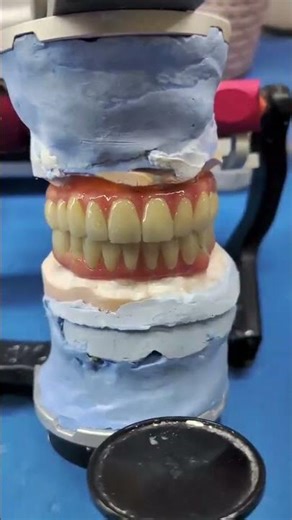DMLS TITANIUM BREDENT HIPC HYBRID DENTURE #dentist #dentallaboratory #32dentaldesign #dentalartistry